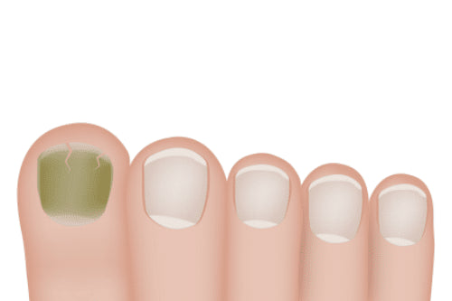 Green Underneath Acrylic Nail: Causes, Concerns, and Solutions